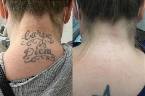 nude tattoo removal|tattoo removal before and after.